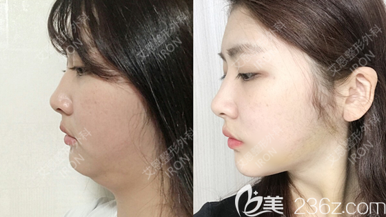 金承俊院长吸脂案例分享