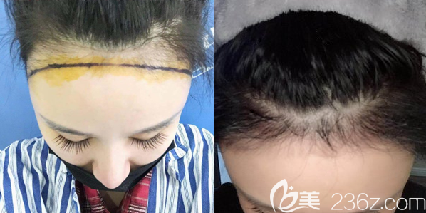 郑州医德佳不剃发植发案例效果图