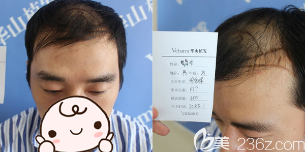 郑州医德佳梁爱峰头顶加密种植手术方案 郑州医德佳梁爱峰头顶加密种植手术方案