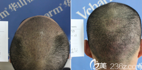 加密种植3500单位术后10天恢复效果 加密种植3500单位术后10天恢复效果