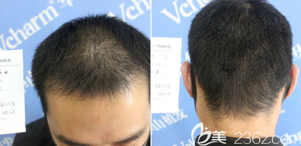 郑州医德佳梁爱峰PTT加密种植1个月效果 郑州医德佳梁爱峰PTT加密种植1个月效果