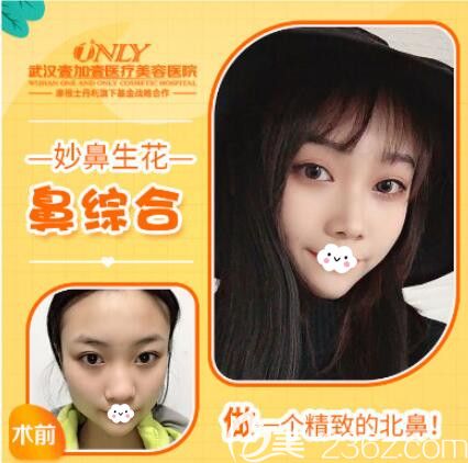 武汉壹加壹自体肋软骨隆鼻案例 武汉壹加壹自体肋软骨隆鼻案例