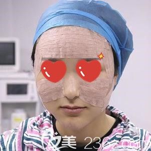 这是我做脂肪填充面部术后即刻的样子