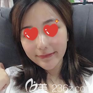 叶凡医生帮我做自体脂肪填充术后8天面部肿胀