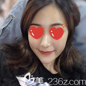 做自体脂肪填充面部术后22天肿胀消40%左右