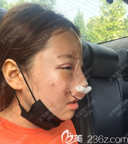 艾恩整形手术当天 艾恩整形手术当天