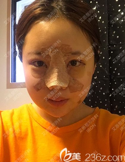 艾恩整形术后第6天 艾恩整形术后第6天