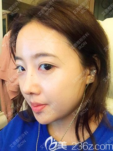 体验了韩国艾恩眼综合+鼻综合手术原来我的眼睛鼻子可以这么美