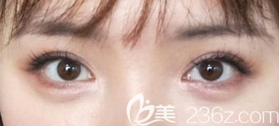 埋线双眼皮一年后效果