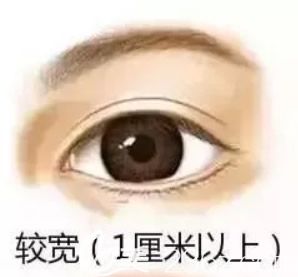 10毫米全切双眼皮恢复后