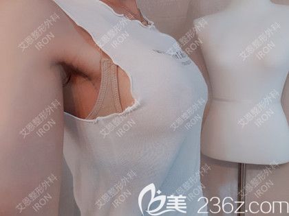 艾恩整形术后第7天 艾恩整形术后第7天