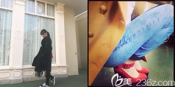 半个月以后大腿吸脂的恢复情况 半个月以后大腿吸脂的恢复情况