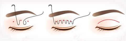 埋线双眼皮手术示意图
