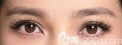 埋线双眼皮术后效果图