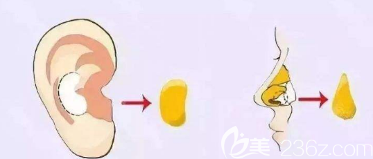 虽然鼻中隔软骨隆鼻的吸收率只有2%左右但是大量取出会让鼻子失去支撑力 虽然鼻中隔软骨隆鼻的吸收率只有2%左右但是大量取出会让鼻子失去支撑力