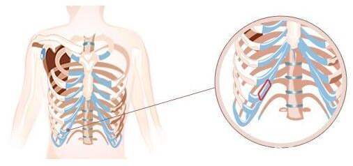 虽然鼻中隔软骨隆鼻的吸收率只有2%左右但是大量取出会让鼻子失去支撑力 虽然鼻中隔软骨隆鼻的吸收率只有2%左右但是大量取出会让鼻子失去支撑力