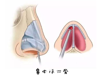虽然鼻中隔软骨隆鼻的吸收率只有2%左右但是大量取出会让鼻子失去支撑力 虽然鼻中隔软骨隆鼻的吸收率只有2%左右但是大量取出会让鼻子失去支撑力