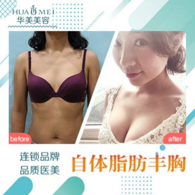 汕头华美丰胸案例