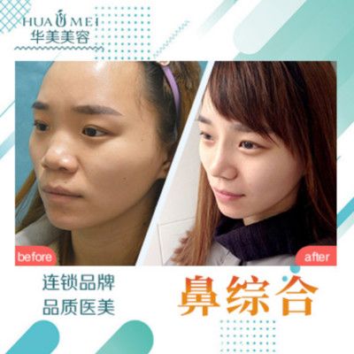 汕头华美整形医院隆鼻案例