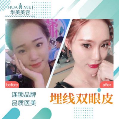 汕头华美整形医院双眼皮案例