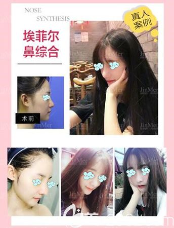 丁院长改善鼻头肥大选择硅胶假体+自体软骨鼻综合 丁院长改善鼻头肥大选择硅胶假体+自体软骨鼻综合