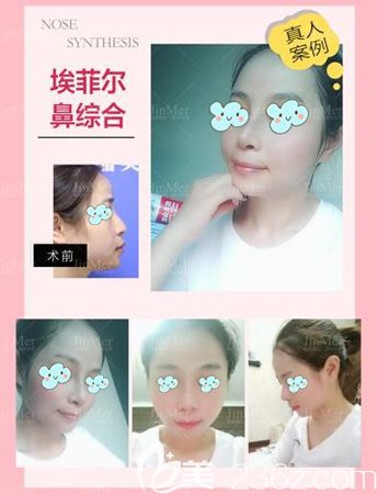 改善轻微驼峰鼻选铜陵晶美做鼻综合手术 改善轻微驼峰鼻选铜陵晶美做鼻综合手术