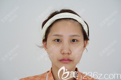 艾恩整形术前照 艾恩整形术前照