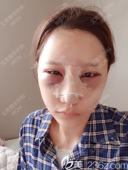 艾恩整形手术当天照 艾恩整形手术当天照