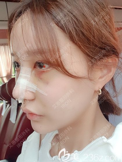 艾恩整形术后第7天 艾恩整形术后第7天