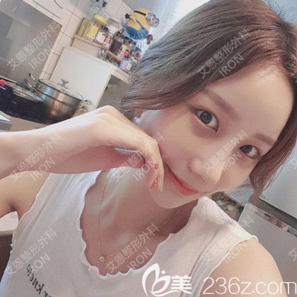 艾恩整形术后第15天 艾恩整形术后第15天