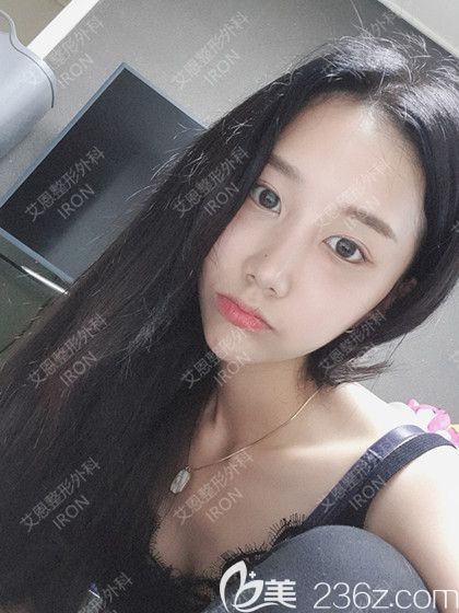 艾恩整形术后一个月 艾恩整形术后一个月