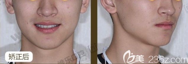 20岁龅牙小哥哥在泉州维乐口腔做隐适美隐形牙齿矫正成功摘牙套啦！