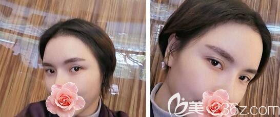 1年前我在武汉华美植发做了发际线种植+眉毛种植,现在好庆幸当初没选择纹发际线