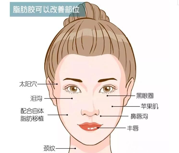 做完脂肪胶填充脸部后悔了,知道这三点避免踩坑