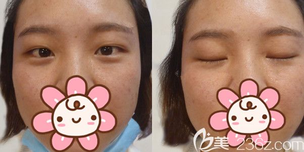 埋线双眼皮一个月变内双 埋线双眼皮一个月变内双