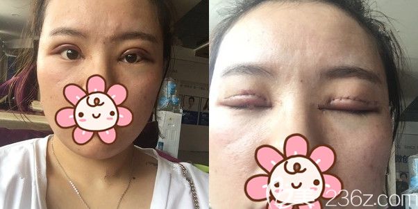 面诊连云港华美医生做了切开修复 面诊连云港华美医生做了切开修复