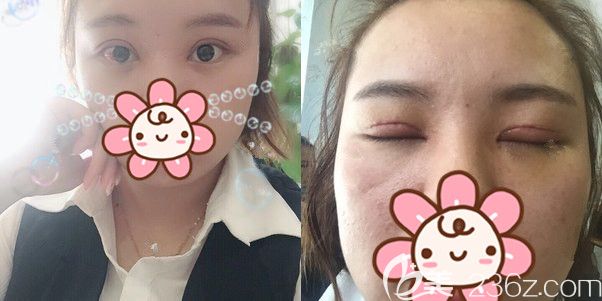 术后三天轻微消肿的双眼皮 术后三天轻微消肿的双眼皮