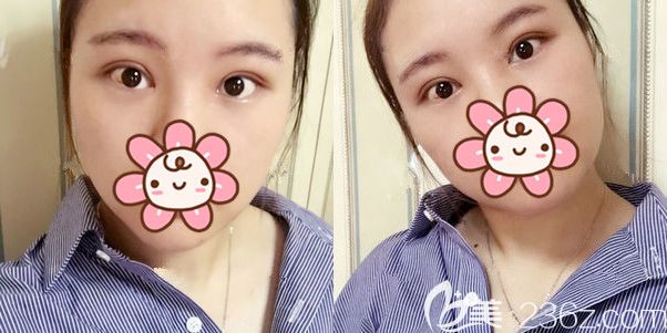 切开重睑修复术后半个月恢复 切开重睑修复术后半个月恢复