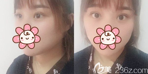 埋线一个月变内双，没办法只好到连云港华美拆了线重新做了切开双眼皮