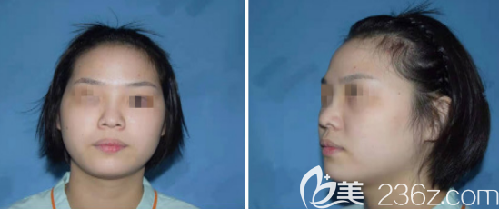 值得开心的是我在济南艺星做面部自体脂肪填充的后鼻梁都变得高挺了很多 值得开心的是我在济南艺星做面部自体脂肪填充的后鼻梁都变得高挺了很多