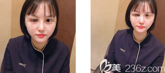 值得开心的是我在济南艺星做面部自体脂肪填充的后鼻梁都变得高挺了很多 值得开心的是我在济南艺星做面部自体脂肪填充的后鼻梁都变得高挺了很多