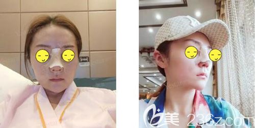 做肋软骨鼻综合术后即刻效果 做肋软骨鼻综合术后即刻效果