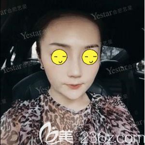 耿继龙主任帮我做鼻综合术后8天依旧肿胀 耿继龙主任帮我做鼻综合术后8天依旧肿胀