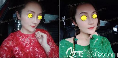 做肋软骨鼻修复术后25天肿胀消除 做肋软骨鼻修复术后25天肿胀消除