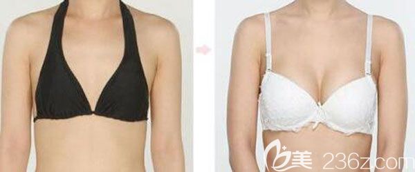 250cc曼托假体丰胸真人效果对比图 250cc曼托假体丰胸真人效果对比图