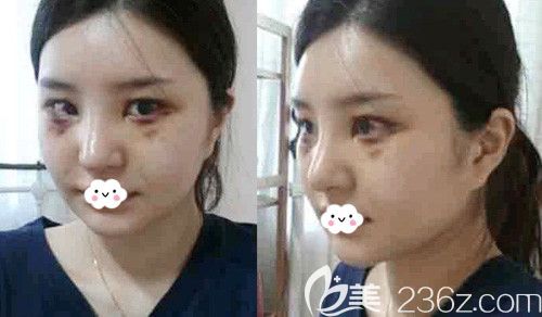 武汉卓美耳软骨复合隆鼻术后7天恢复图