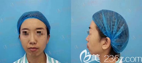 鼻整形手术前照片 鼻整形手术前照片