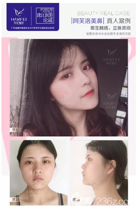 广州韩妃沈绍勇鼻综合隆鼻案例 广州韩妃沈绍勇鼻综合隆鼻案例