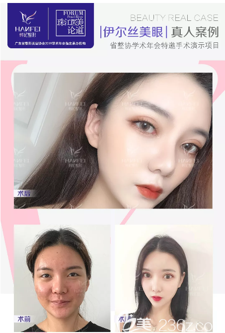 广州韩妃李光琴双眼皮案例 广州韩妃李光琴双眼皮案例