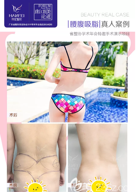 广州韩妃于洪瑞腰腹部吸脂案例 广州韩妃于洪瑞腰腹部吸脂案例